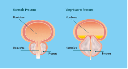 Vergleich: Gesunde Prostata vs. vergrösserte Prostata